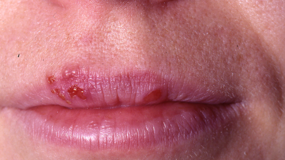 Forkølelsessår (Herpes Labialis) hvad er det og hvordan kan man behandle det